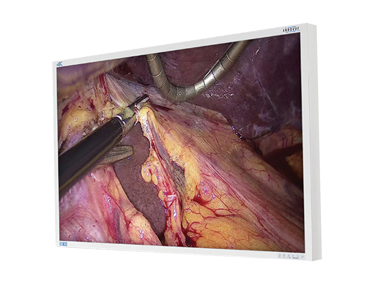 NDS EndoVue Plus 55" BC-WK55-A1B20 4K Surgical Endoscopy Medical Display Monitor 1 NDS EndoVue Plus 55" BC-WK55-A1B20 4K Surgical Endoscopy Medical Display Monitor