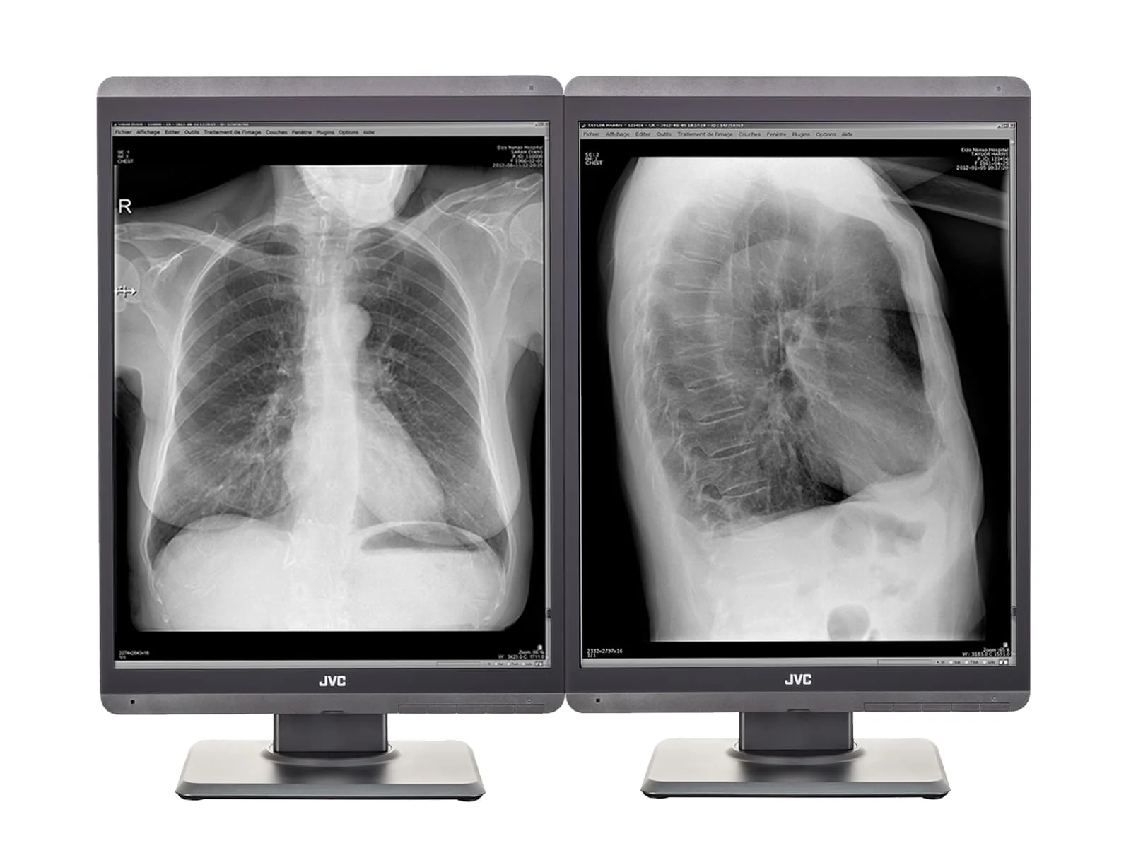 JVC Totoku MS-S300 3MP 21" Grayscale General Radiology Diagnostic Display Monitor (MS-S300) 1 JVC Totoku MS-S300 3MP 21" Grayscale General Radiology Diagnostic Display Monitor (MS-S300)