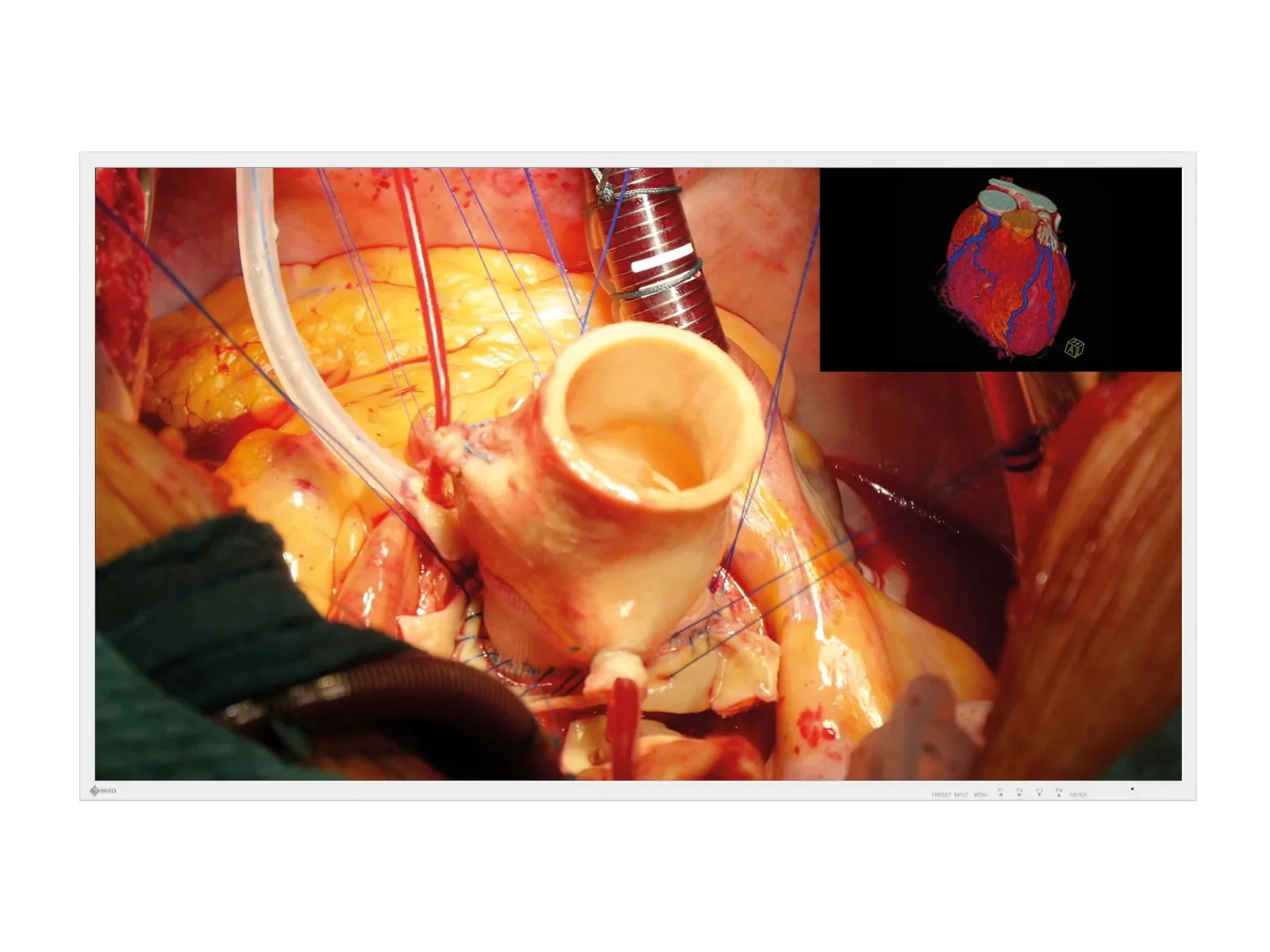 Eizo 43" 4K UHD Surgical Endoscopy Medical Display Monitor (EX4342)