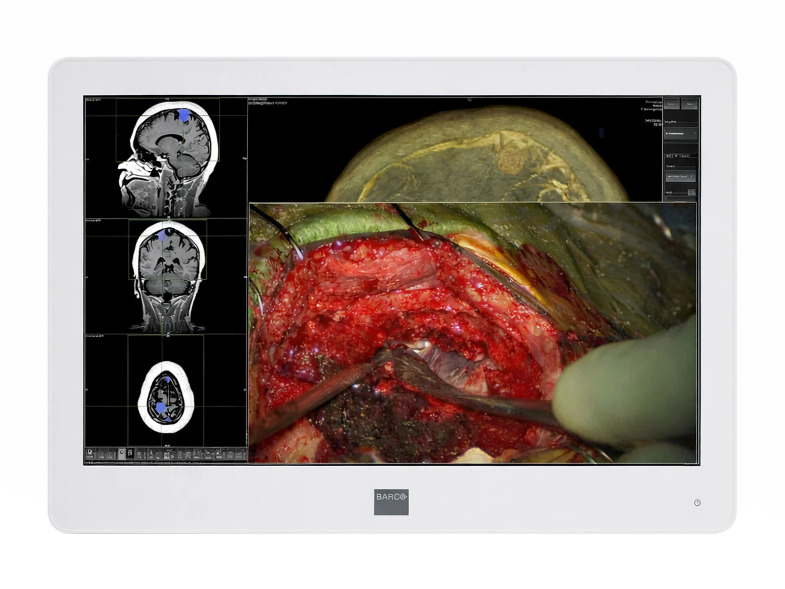 Barco MDSC-2224 MNA 24" 2MP FHD 1920 x 1200 Surgical Endoscopy Medical Display Monitor (K9307913)